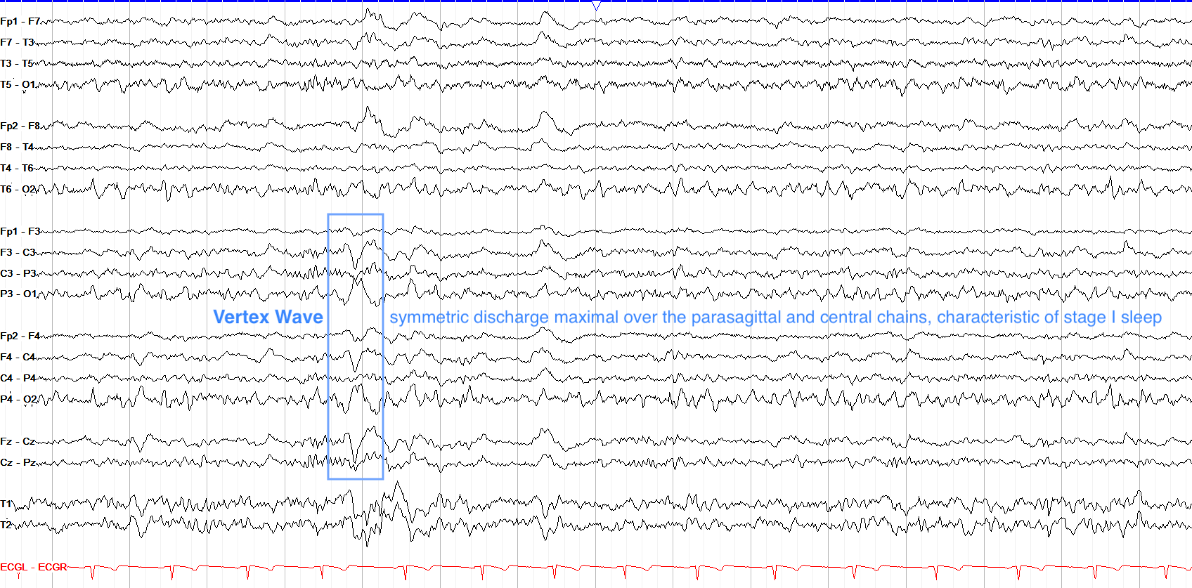 Vertex wave